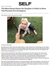 Self - Dr. Gary Goldenberg is quoted in This Mom Always Kisses Her Daughter in Public to Show That Psoriasis Isn't Contagious