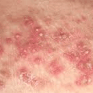 psoriasis doctor nyc