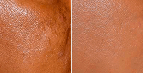 enlarged pore treatment nyc