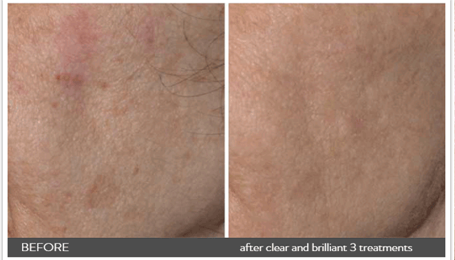 clear brilliant laser skincare nyc