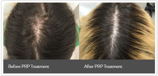 PRP Hair Loss Treatment | NYC - Goldenberg Dermatology