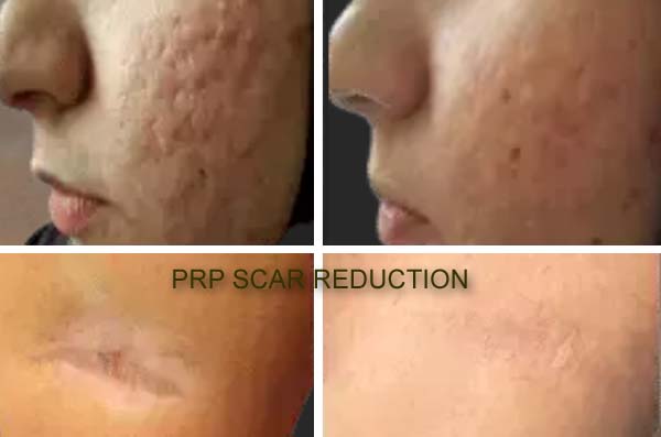 Derma PRP Before & After Derma PRP Before & After