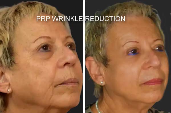 Derma PRP Before & After Derma PRP Before & After