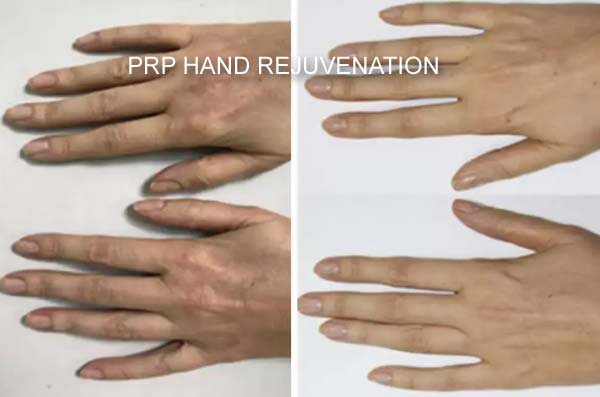 Derma PRP Before & After Derma PRP Before & After