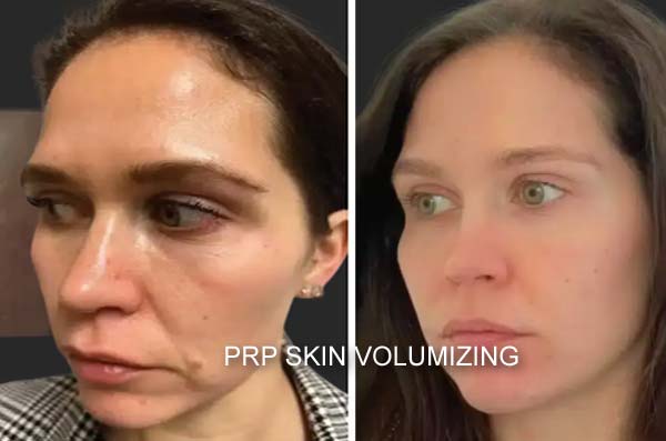 Derma PRP Before & After Derma PRP Before & After